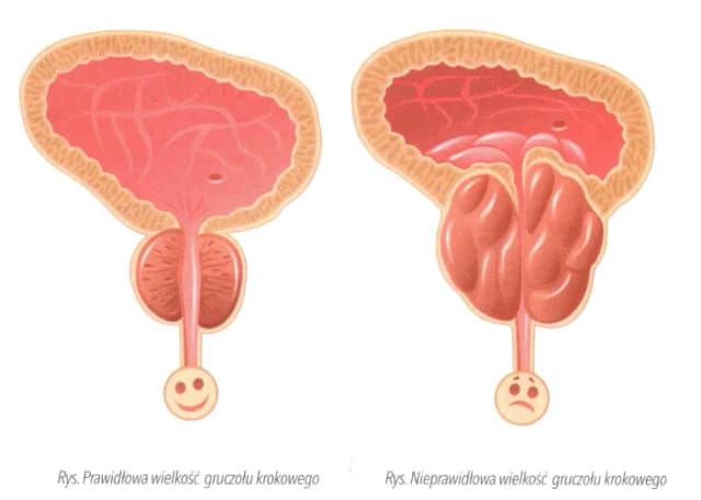Objawy prostaty po 50 – nie ignoruj tych sygnałów zdrowotnych Objawy prostaty po 50 – nie ignoruj tych sygnałów zdrowotnych