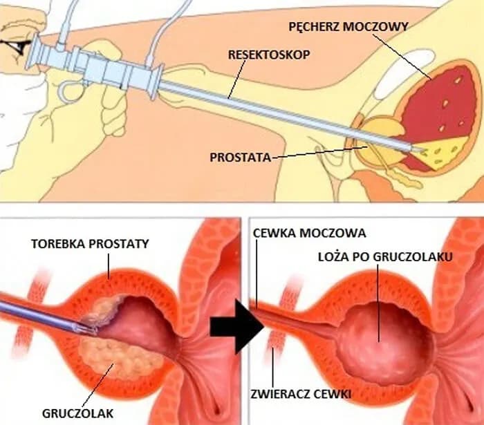 Czy pacjent ma prawo do sanatorium po operacji prostaty? Sprawdź warunki Czy pacjent ma prawo do sanatorium po operacji prostaty? Sprawdź warunki